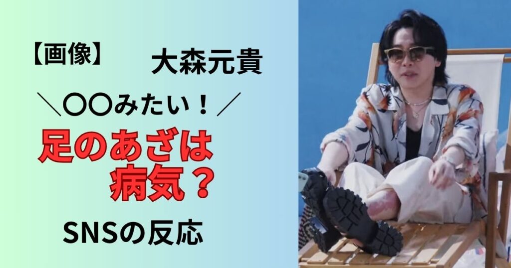 大森元貴の足のあざは病気?生まれつき?原因調査!
