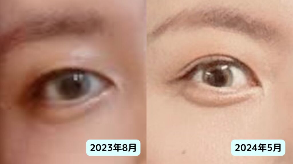 ミセス藤澤涼架は整形?鼻が高い理由と二重幅はいつからか