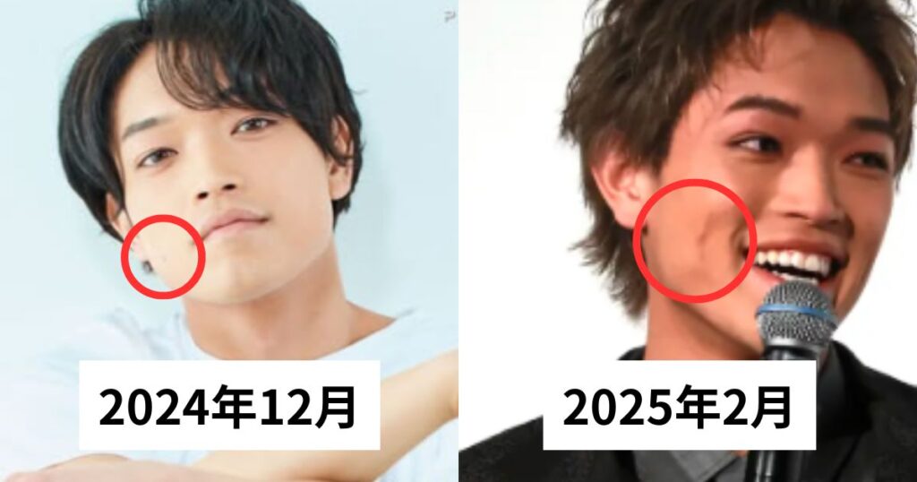 Timeleszの原嘉孝のほくろいつ取った？メイクで隠したのか整形なのか画像比較で調査